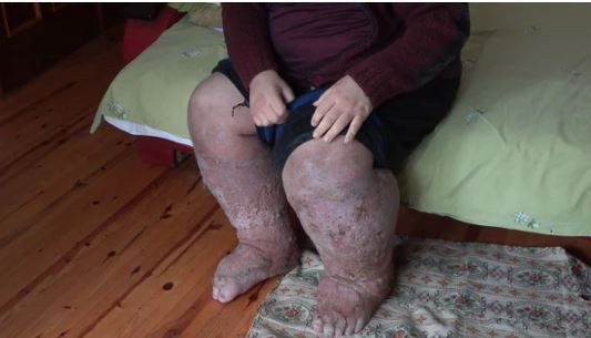 'Ölüm belki kurtuluşumdur' demişti, sivrisineğin ısırdığı güvenlik görevlisi yaşama tutunamadı - Resim: 2