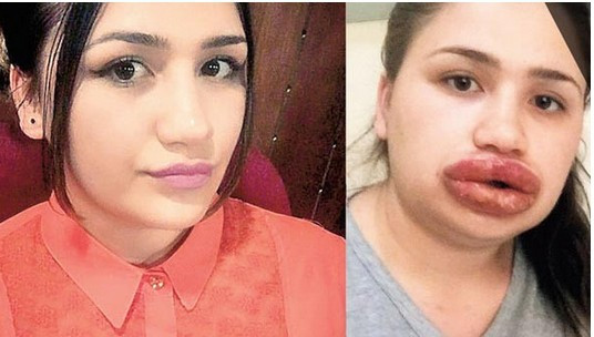 Silikon faciasında bomba gelişme dudak dolgusu yapan kuaför... - Resim: 4