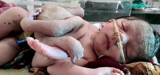 Hindistan'da bir ilk! Tıp dünyası şokta 4 bacaklı 3 kollu doğdu - Resim: 2