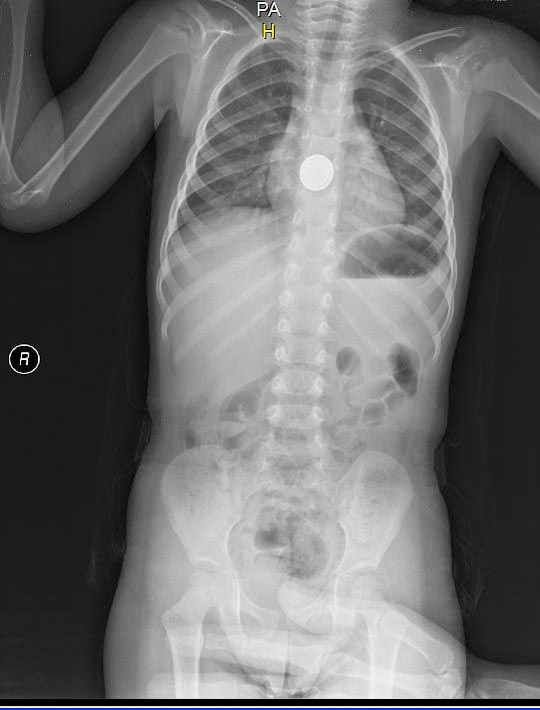 Küçük Efe pil yutunca olanlar oldu - Resim: 2