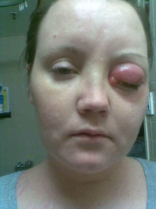 Lensinden bulaşan mikrop hayatını kararttı - Resim: 2