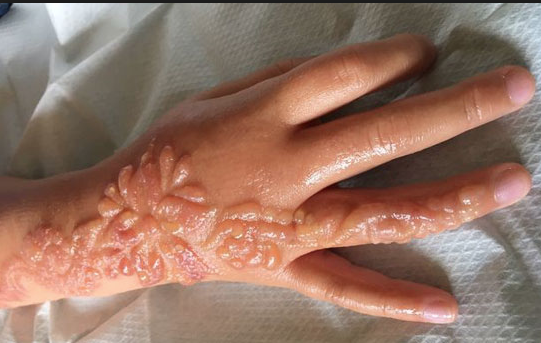 Kesinlikle yaptırmayın cilde inanılmaz zararları bulunuyor! - Resim: 3