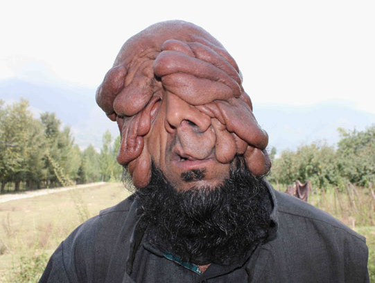 Yüzü olmayan adamın mucize bebeği - Resim: 4