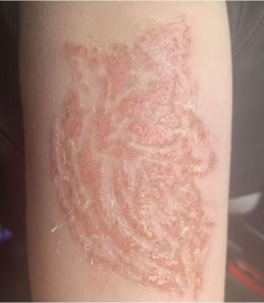 Türkiye tatilinde yaptırdığı kına dövmesi minik İngiliz çocuğun hayatını kararttı - Resim: 2