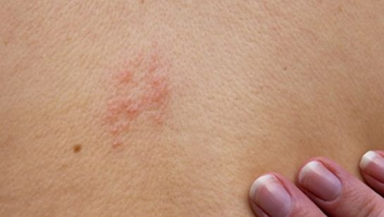 Zona belirtileri neler zonaya ne iyi gelir? - Resim: 3