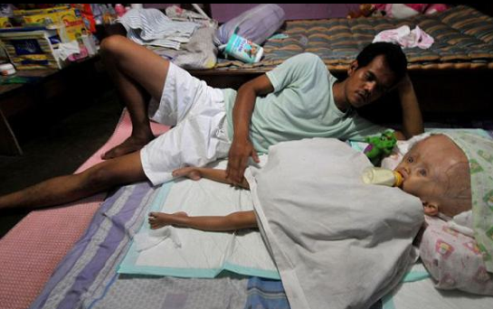 Bu çocuğun kafası sürekli büyüyor - Resim: 4