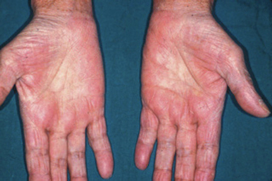 Avucunuzu açın ve dikkatli bakın! Kızarıklık varsa hiç durmayın hemen doktora gidin! - Resim: 0