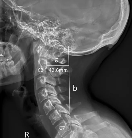 Aşırı cep telefonu kullanımı boynuz çıkıyor! - Resim: 3