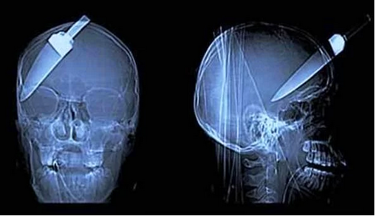 XRay'lerde insanların içinde görüntülenen en acayip şeyler - Resim: 3