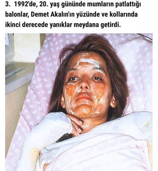 Yanık yüzle tanınmaz hale gelen Demet Akalın o anı ilk kez paylaştı - Resim: 2