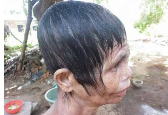 Et yiyen virüs kadının yüzünü yedi - Resim: 2