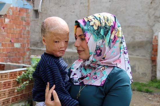 Aydın'da yaşayan Halil Geyik'in ameliyatı için gerekli para toplandı - Resim: 1