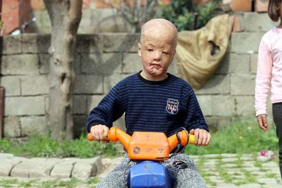 Aydın'da yaşayan Halil Geyik'in ameliyatı için gerekli para toplandı - Resim: 4