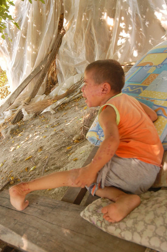 Bu çocuk 8 yıldır kaşınıyor - Resim: 1