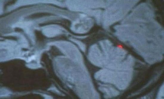 İkizi beyninde büyüdü - Resim: 4