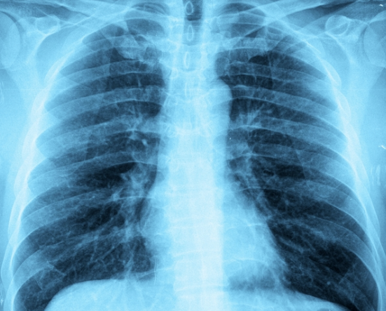 Akciğer lekesi nedir belirtileri nelerdir? Tedavisi var mıdır? - Resim: 2