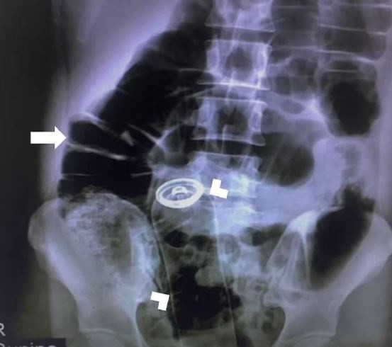 Cinsel tatmin için kullandığı deodorant kutusu yüzünden hastanelik oldu - Resim: 0