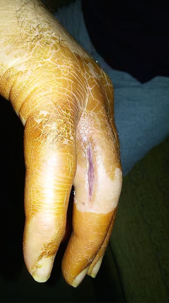 Eline kürdan battı hayatı kabusa döndü arkadaşlarımı arayıp hellalik istedim - Resim: 0