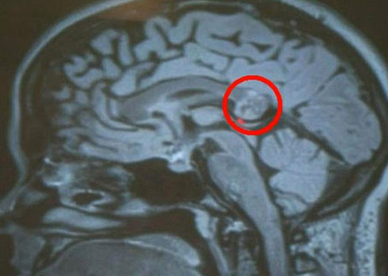 İkizi beyninde büyüdü - Resim: 2