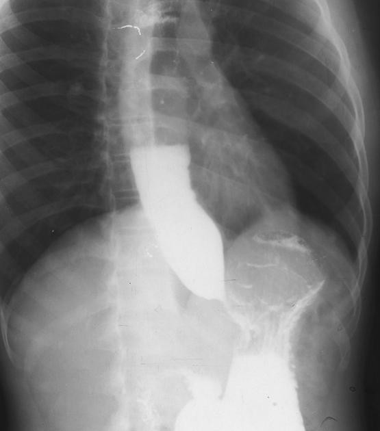 Reflünüz bir türlü geçmiyorsa bu hastalığa yakalanmış olabilirsiniz! - Resim: 2