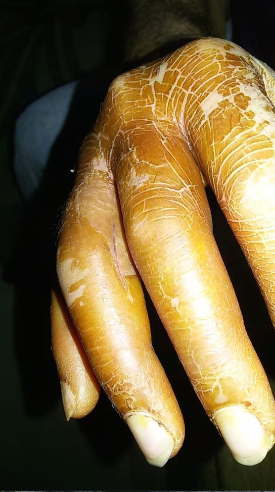 Eline kürdan battı hayatı kabusa döndü arkadaşlarımı arayıp hellalik istedim - Resim: 1