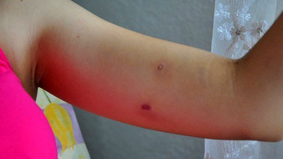 Çanakkale'de 17 yaşındaki Hilal Yavaş kız evine giderken arıların saldırısına uğradı! - Resim: 1