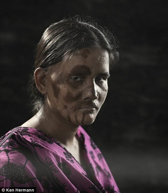 Asit saldırısı kurbanları... - Resim: 4