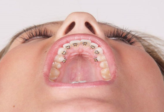 Diş telinden haz etmeyenlere müjde! Bu iki yöntemi deneyin - Resim: 2