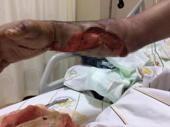 Yaraladığı yılan geri dönüp soktu - Resim: 0