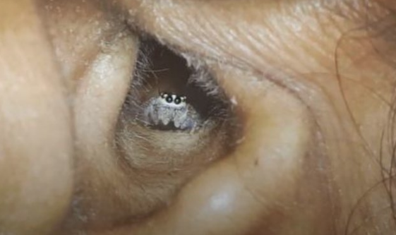 Baş ağrısı şikayetiyle gitti bakın kulağından ne çıktı? - Resim: 3