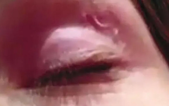 Hareket edince farkına vardı! Kadının gözüne giren solucan ameliyatla çıkarıldı - Resim: 0