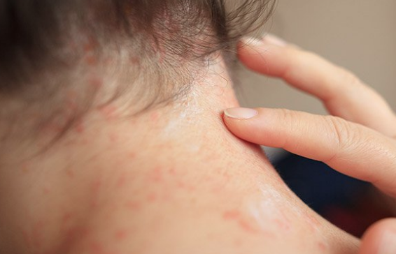 Sedef hastalığı nedir tedavisi var mıdır? - Resim: 1