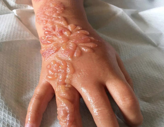 Kesinlikle yaptırmayın cilde inanılmaz zararları bulunuyor! - Resim: 1