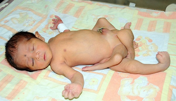 6 bacaklı bebek dehşete düşürdü - Resim: 1