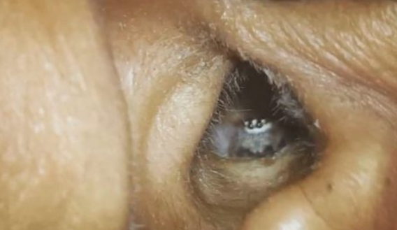 Baş ağrısı şikayetiyle gitti bakın kulağından ne çıktı? - Resim: 1