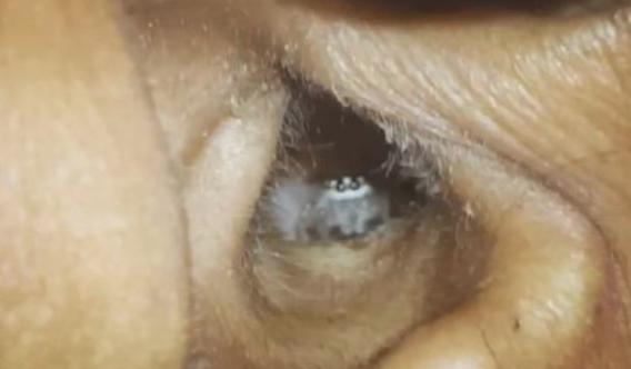 Baş ağrısı şikayetiyle gitti bakın kulağından ne çıktı? - Resim: 2