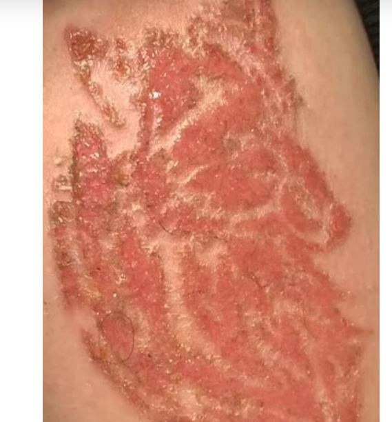 Türkiye tatilinde yaptırdığı kına dövmesi minik İngiliz çocuğun hayatını kararttı - Resim: 3