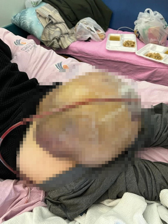 Şanlıurfa'da hastanın kalçasından 10 kilo tümör çıktı - Resim: 0