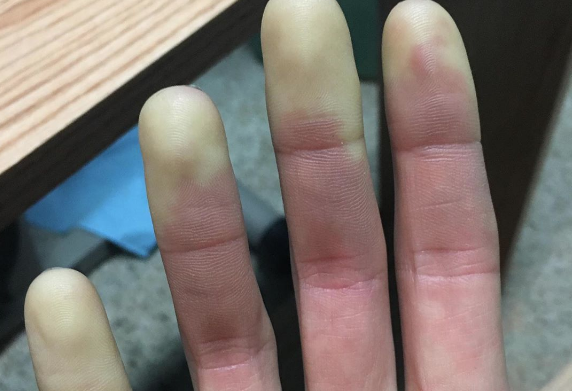 Elleri üşüyenler dikkat! Bu hastalıkların habercisi olabilir - Resim: 0