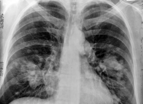 Vücuda büyük zarar veren akciğer lekelenmesinin nedenleri - Resim: 0