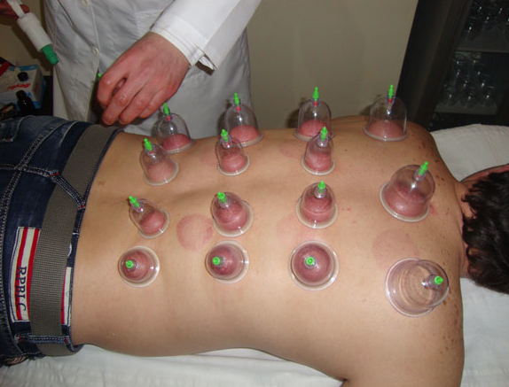 Peygamber sünneti olan hacamat nedir? - Resim: 2