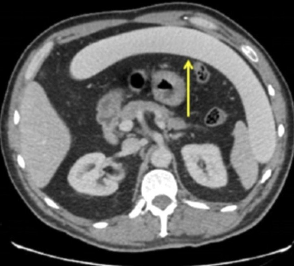 Akıllara durgunluk veren olay sarhoş adamın anüsünden bu çıktı - Resim: 1