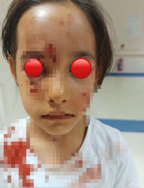 İstanbul'da başıboş köpek dehşeti! 6 yaşındaki kızın yüzünü parçaladı! Küçük kız kuduz mu oldu? - Resim: 2