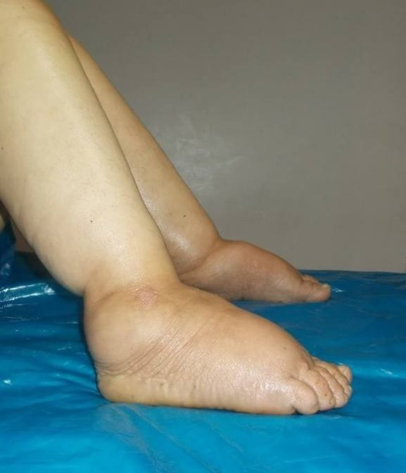 31 yıl sonra fil hastalığını yendi - Resim: 4