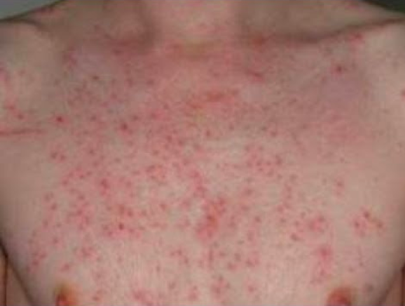 Vücutta lekeler neden olur-kırmızı leke neyin belirtisi? - Resim: 1