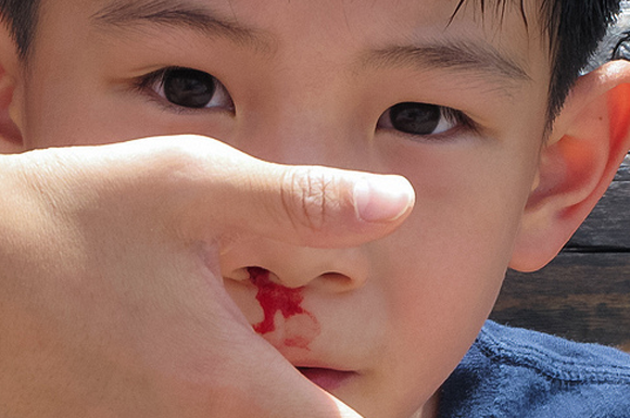 Burun kanamasını ciddiye alın! - Resim: 3