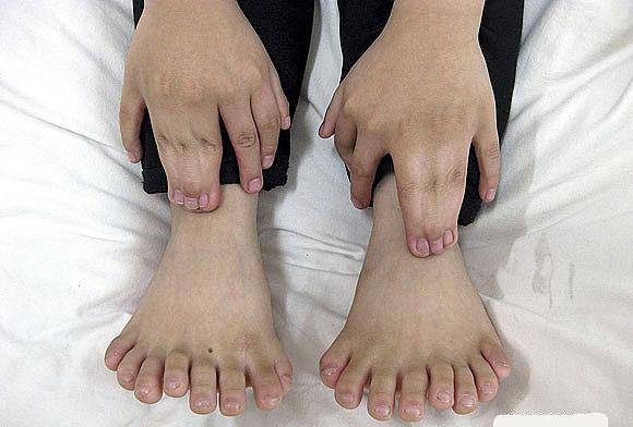 Tam 30 tane parmağı var! - Resim: 1