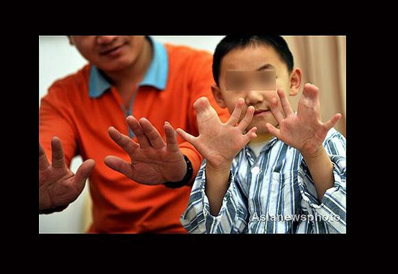 Tam 30 tane parmağı var! - Resim: 4