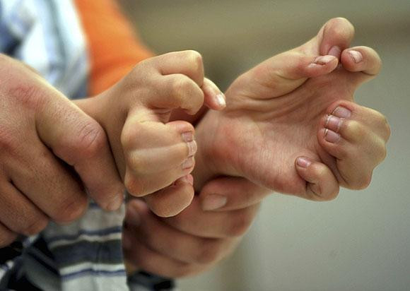 Tam 30 tane parmağı var! - Resim: 3