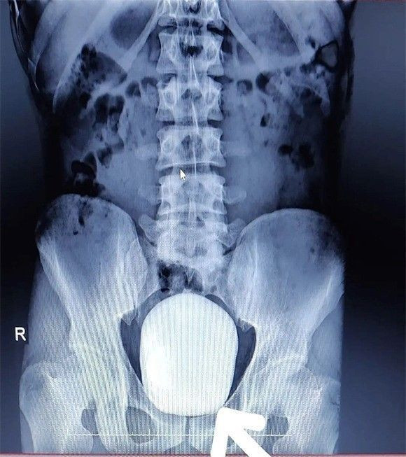 Türkiye'de böylesi görülmedi patatese benziyor Karamanlı gencin mesanesinden çıktı - Resim: 2